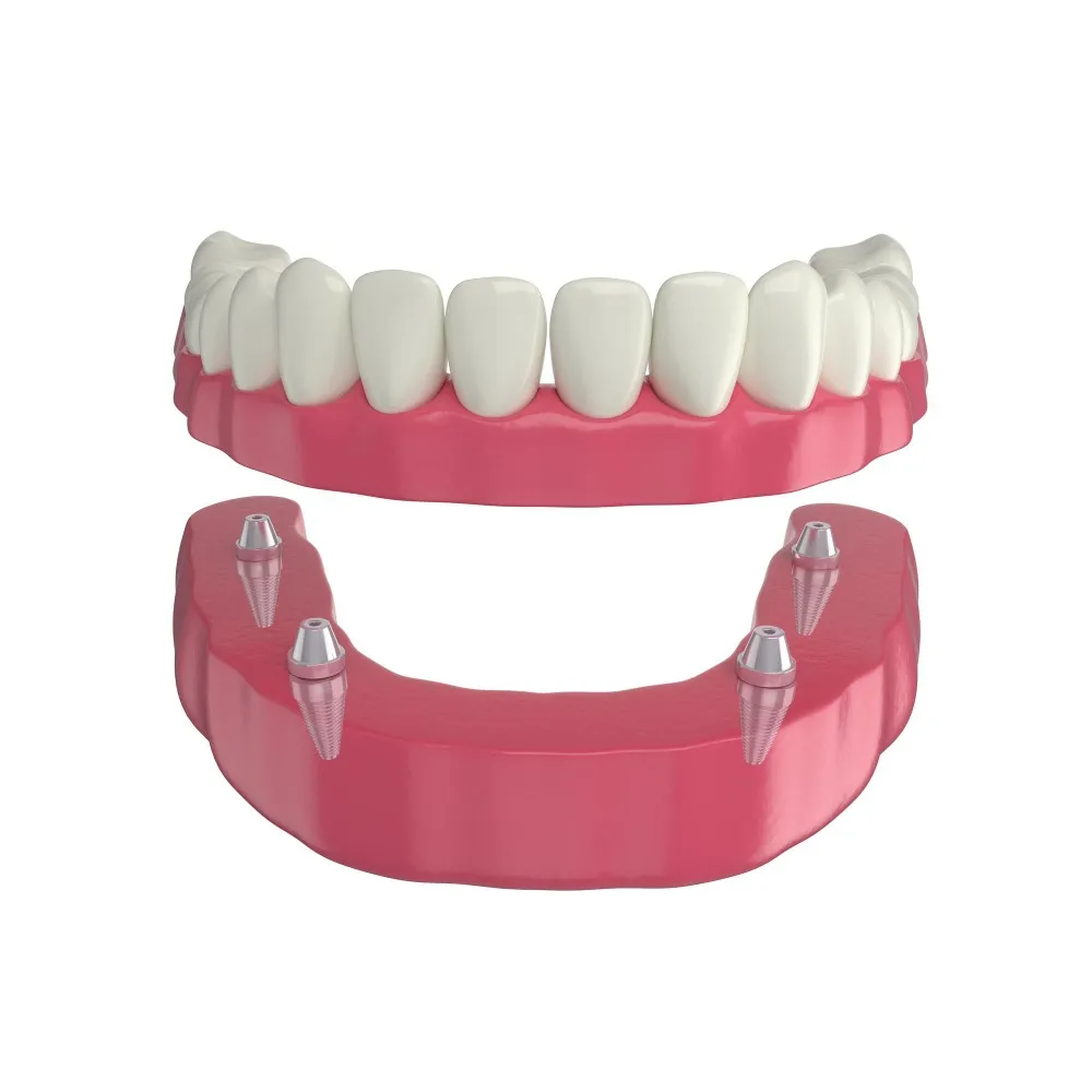 Immediate Full Mouth Implants in Dwarka for Faster Smile Rehabilitation