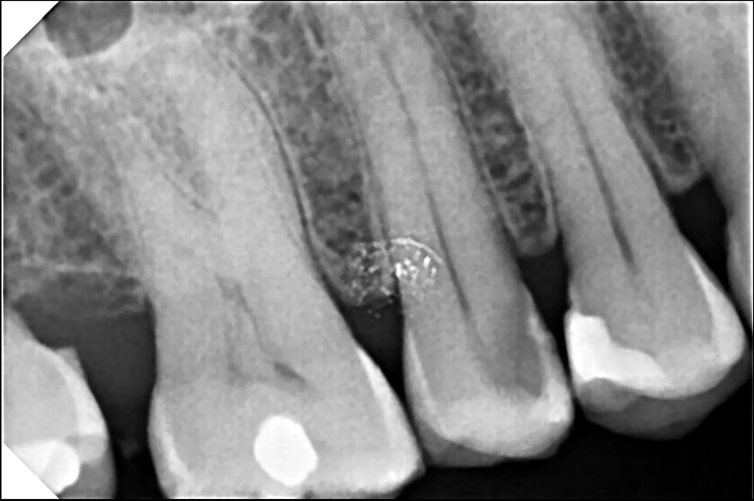 Emergency Dentist in Thane: What to Do During Severe Tooth Pain