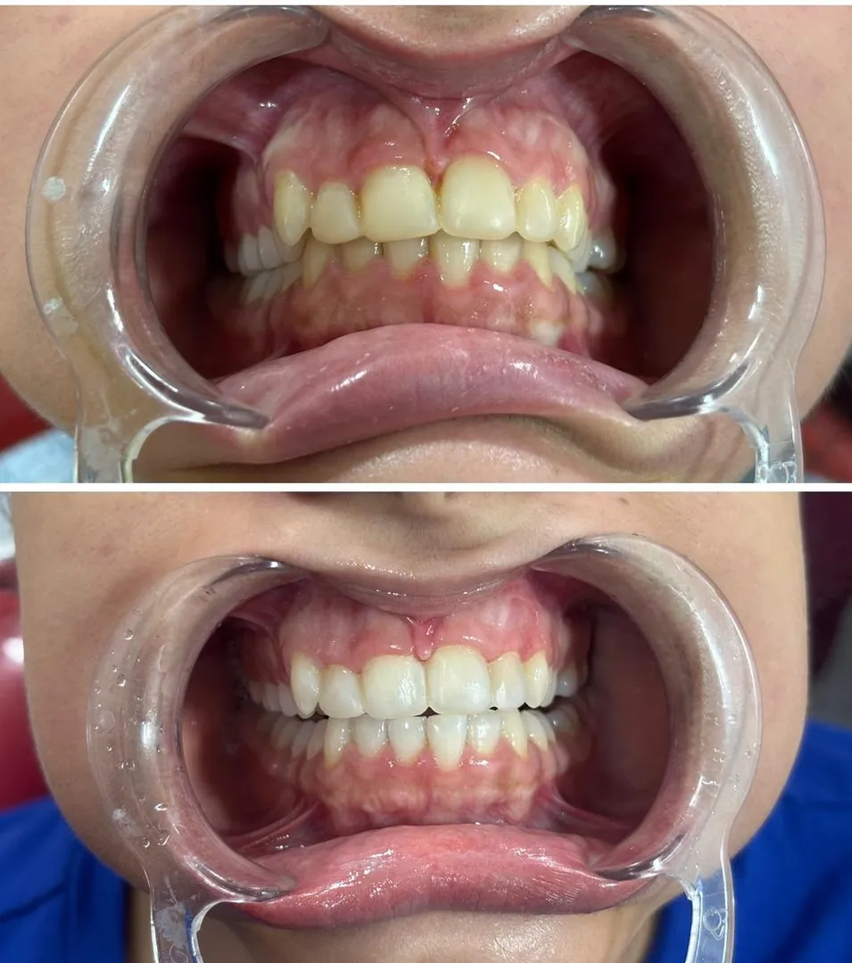 Dental Tourism in India: Affordable Smile Makeovers for Overseas Patients