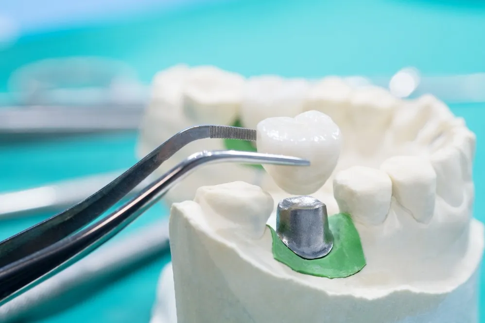 Zirconia Crown in Vikas Puri Stronger Restorations With a Natural Appearance