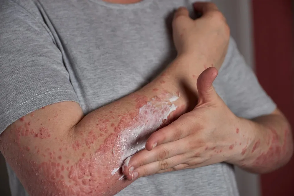 Psoriasis Treatment in Sus for Long-Term Skin Comfort