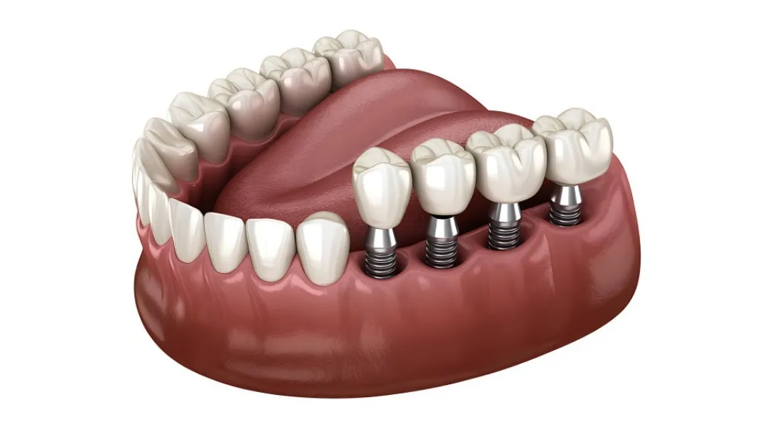 Basal Implants in Badlapur – Understanding Advanced Implant Dentistry