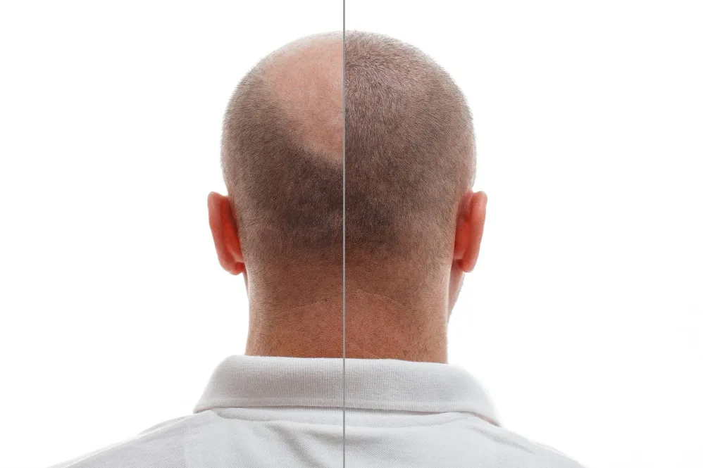 Hair Restoration in Kotturpuram – Finding the Right Path Towards Healthier Hair