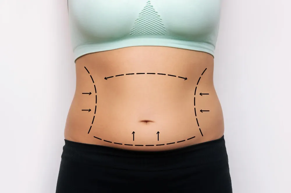 Liposuction Surgery in Bengaluru