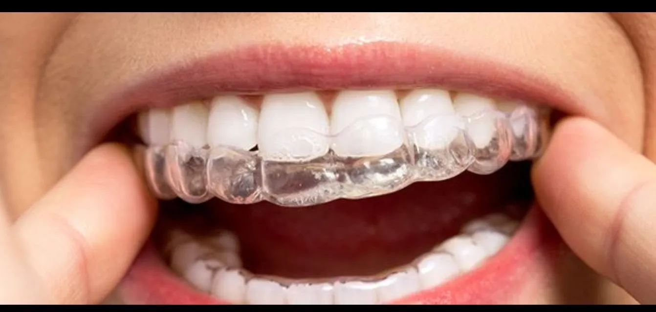 Clear Aligners in Thane: Treatment Timeline, Cost & Results