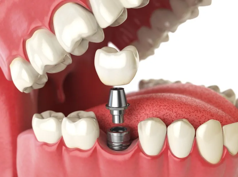 Implant Specialist in Nashik