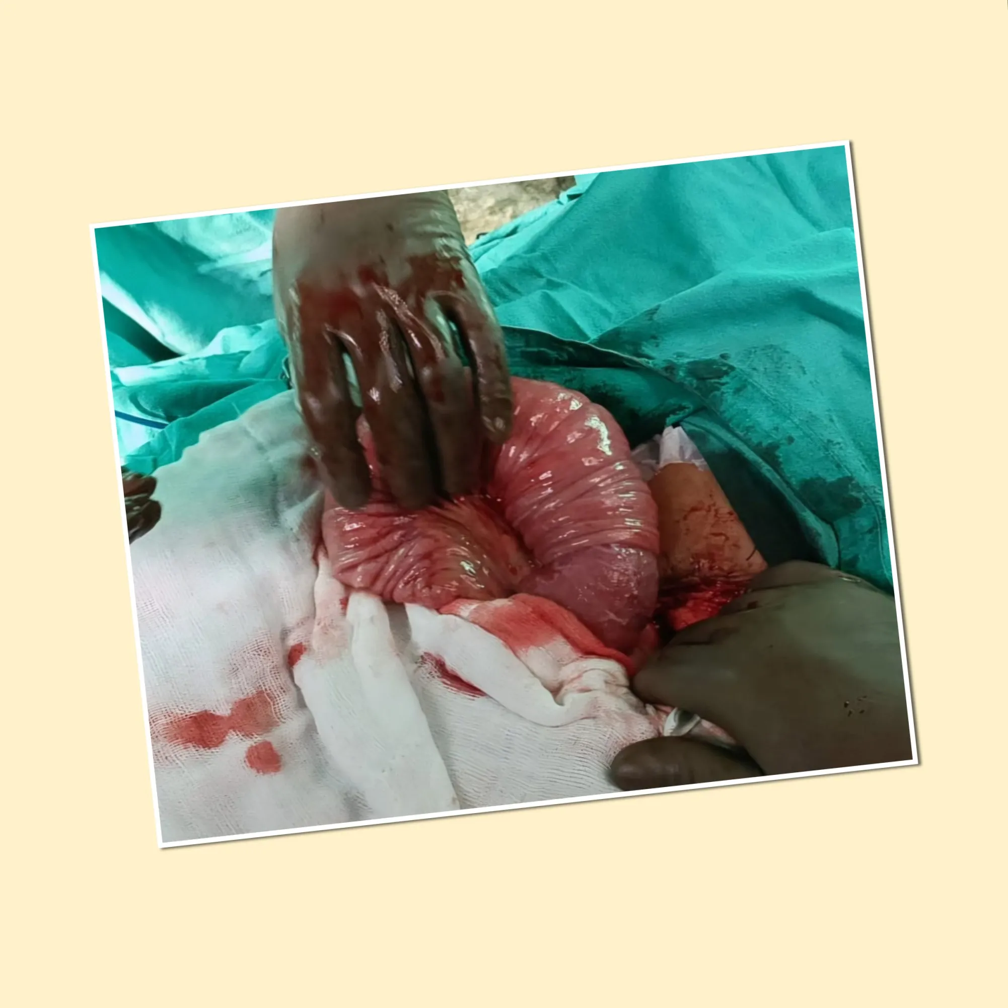 intussusception in adults