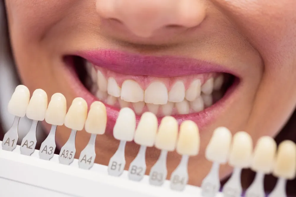 Dental Veneers in Chittaranjan Park – Small Changes That Create Lasting Impressions