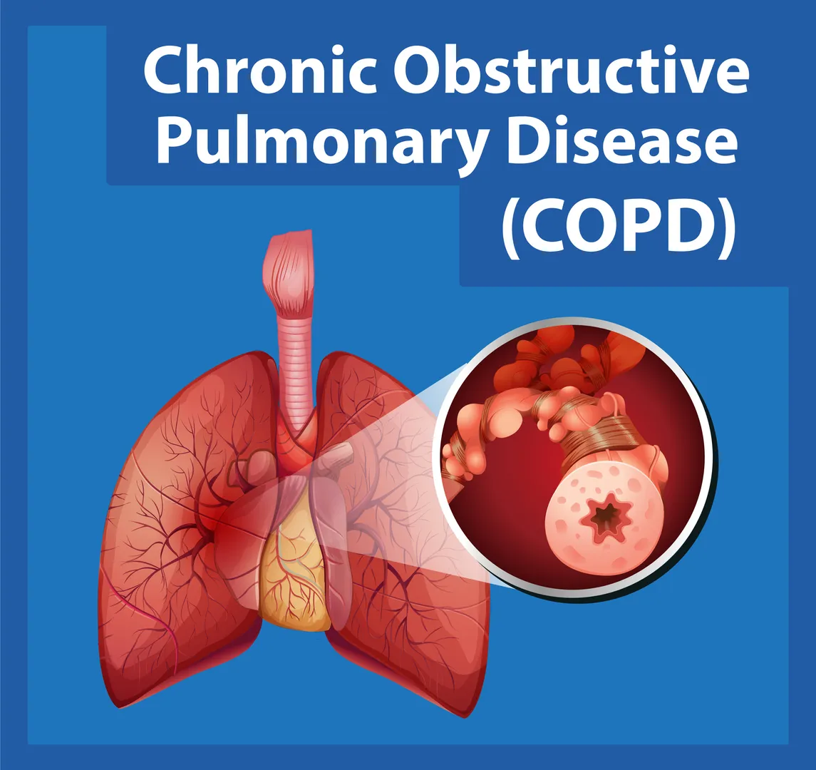 COPD Treatment in Jaipur – Comprehensive Care by Dr. Shubham Sharma
