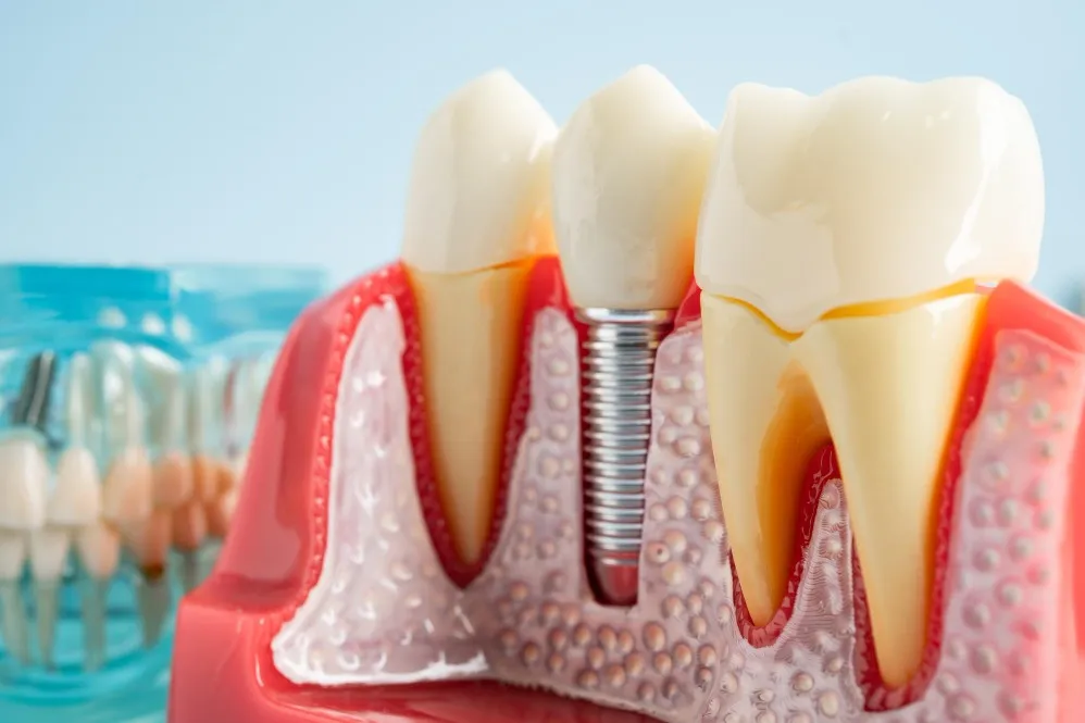 Fixed Implant Dentures Treatment in Delhi for Better Stability and Comfort