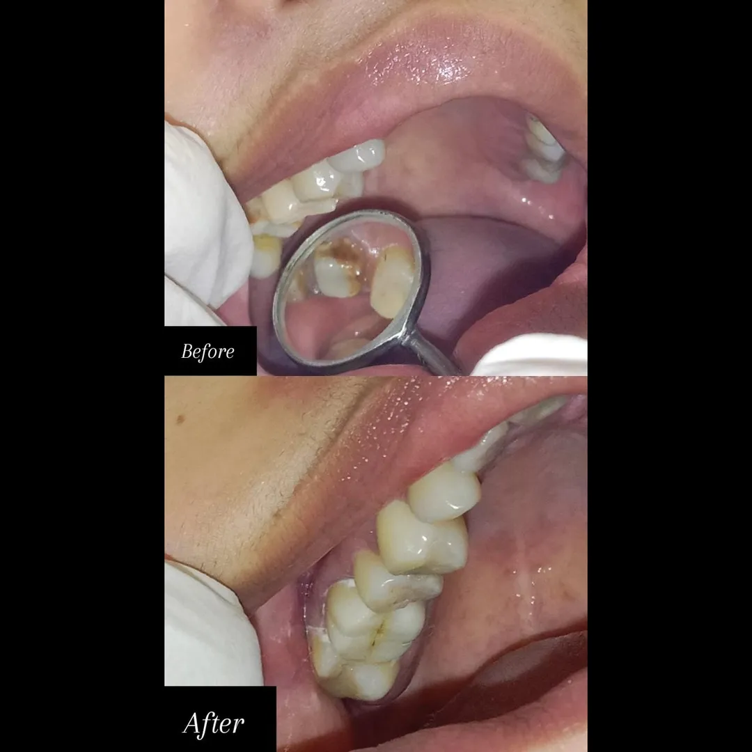 CAP CEMENTATION TREATMENT IN VASHI