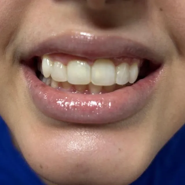 Professional Teeth Whitening in Mulund West: Is It Worth It?