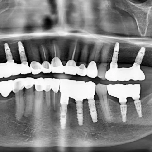 How Long Does Root Canal Treatment Take? Timeline Explained by Dentists in Mulund West Mumbai
