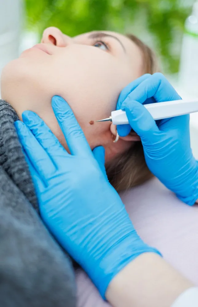 Best Mole Removal Treatment Specialist in Kalas
