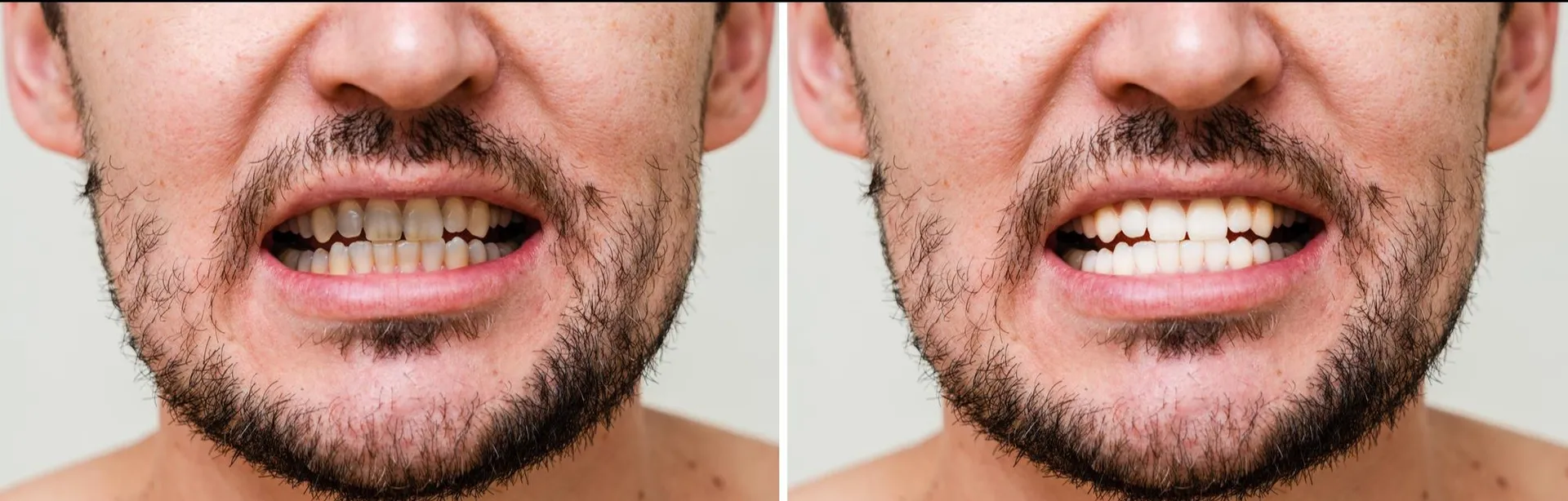 Full Mouth Rehabilitation in Hebbal