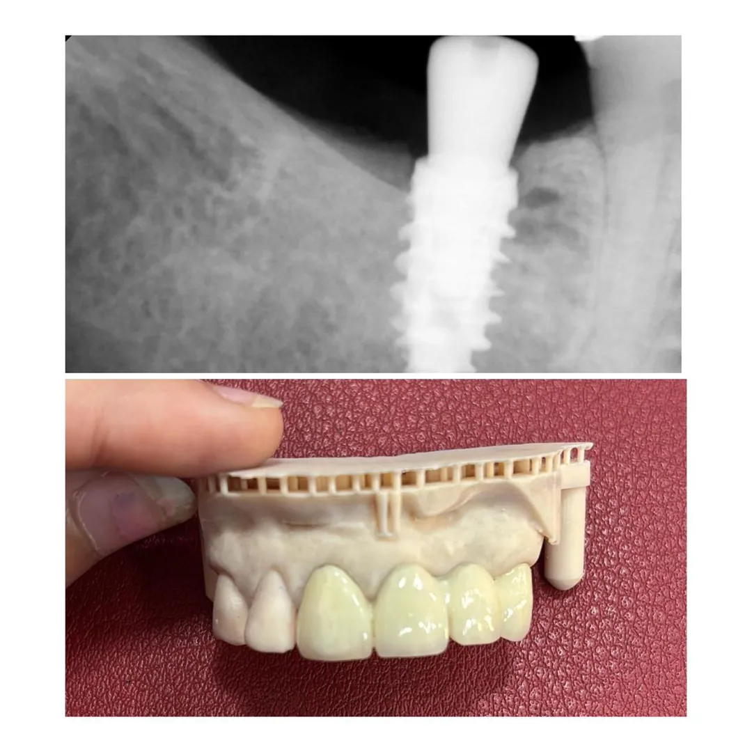Dental Implant vs Bridge: Which Option Is Better for Missing Teeth in Thane?