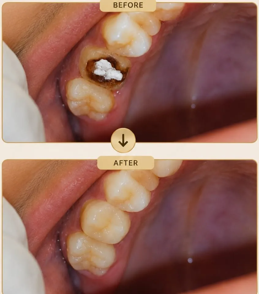 CAP CEMENTATION TREATMENT IN VASHI