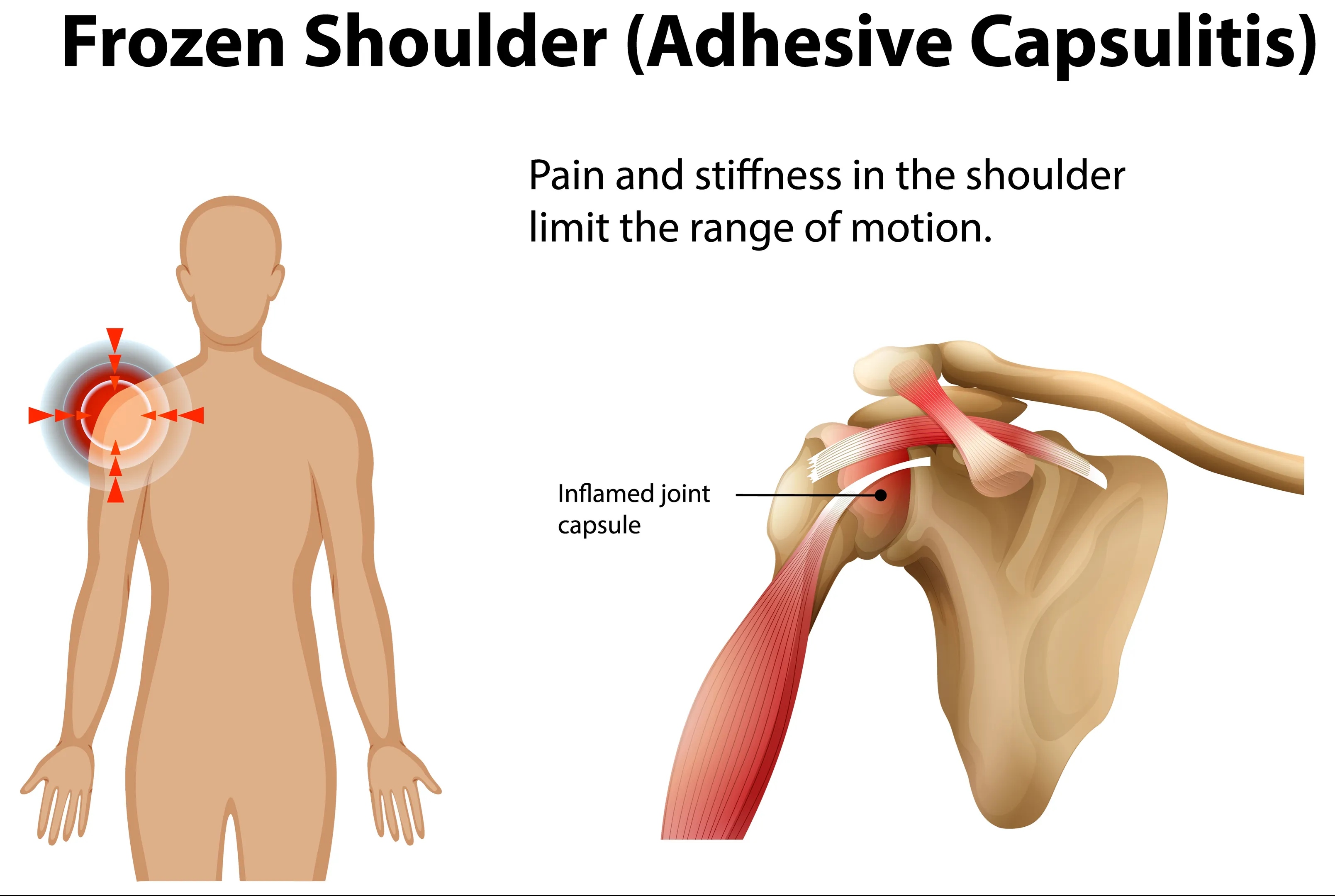 Physiotherapy for Frozen Shoulder: Why Early Treatment Improves Recovery