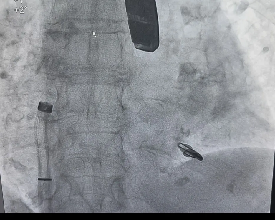 Mitra Clip in Navi Mumbai – Managing Mitral Valve Leakage with Advanced Cardiac Care