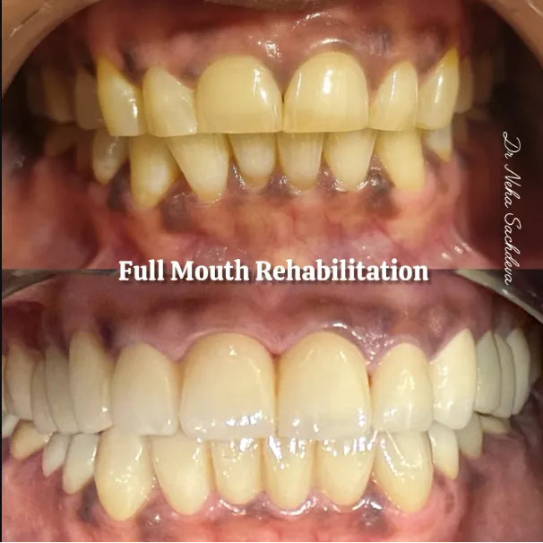 Full Mouth Rehabilitation in Kalkaji – Restoring Function, Comfort, and Confidence