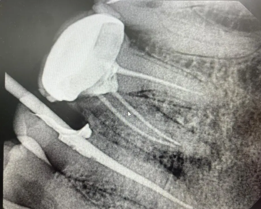 How Long Does Root Canal Treatment Take? Timeline Explained by Dentists in Mulund West Mumbai
