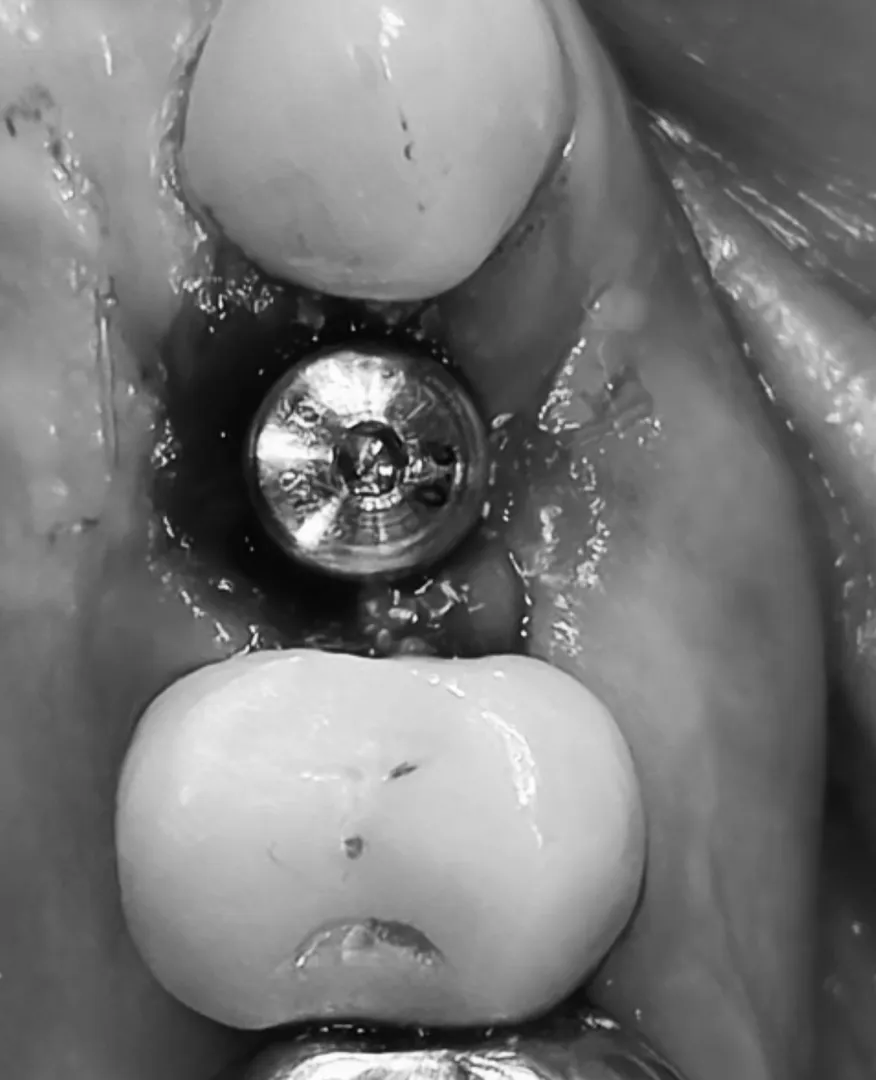 Dental Implants in Mulund West Mumbai: Procedure, Healing & Cost