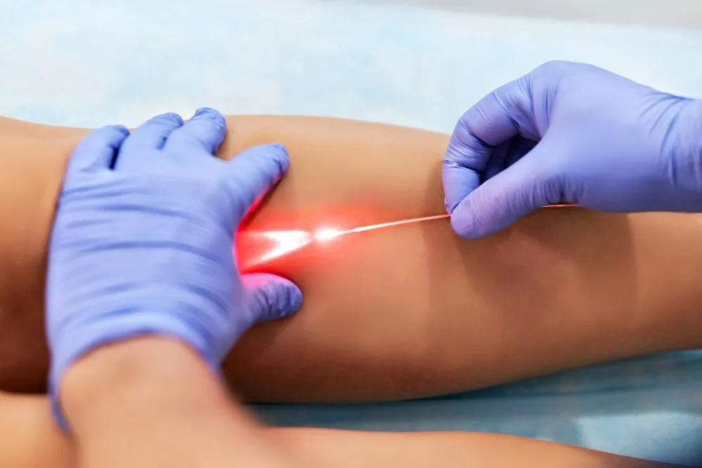 Varicose Veins Laser Surgery Near Lalbaug for Leg Pain Relief