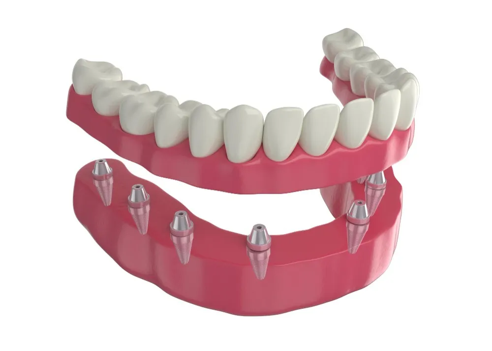 Implant Overdentures in Malwadi
