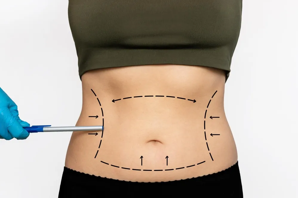 Tummy Tuck Surgery in Bengaluru