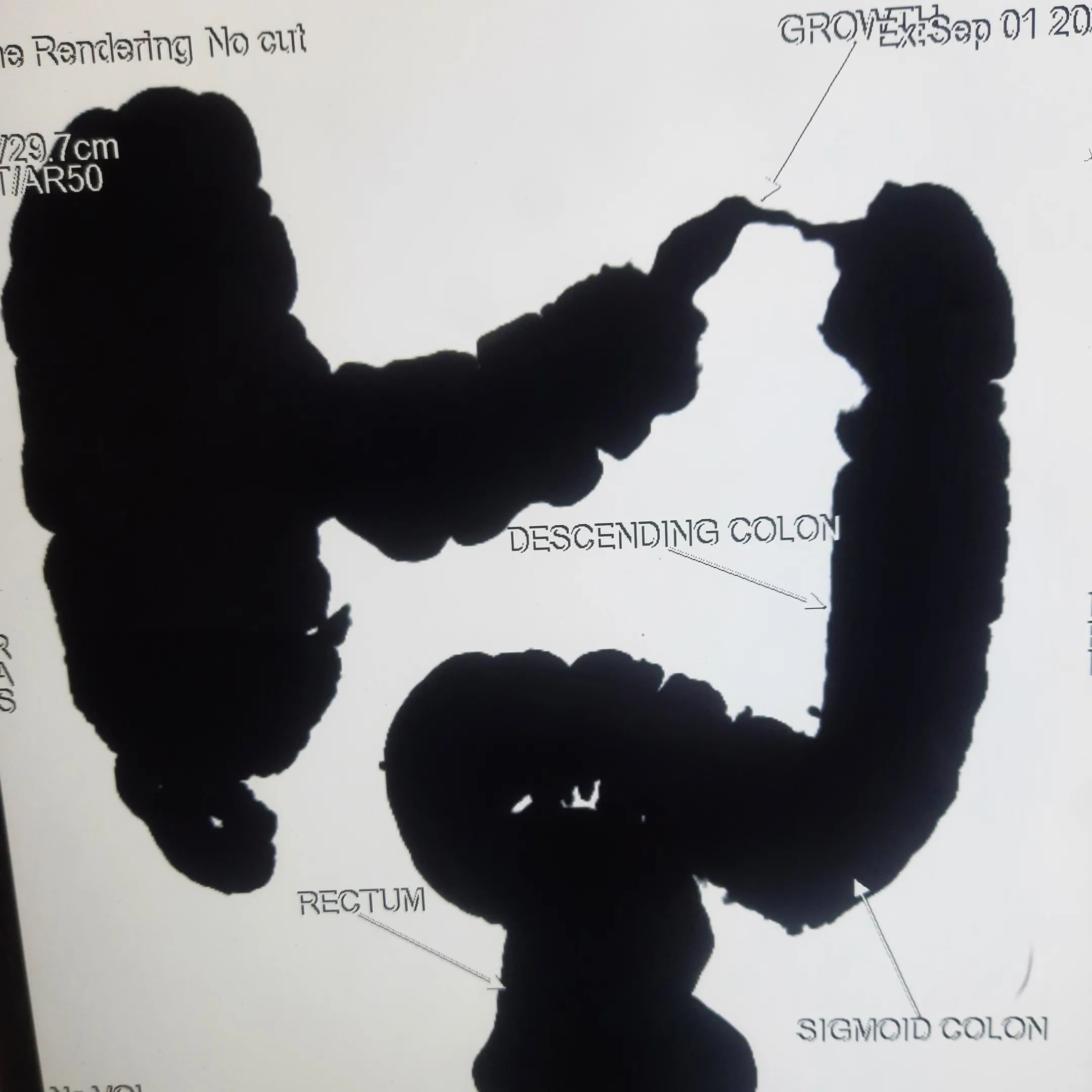Distal transverse colon growth