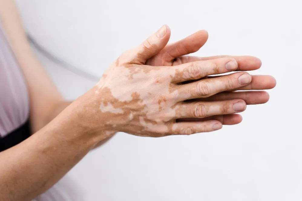 Vitiligo Treatment in Aundh – Understanding White Patches with Expert Care