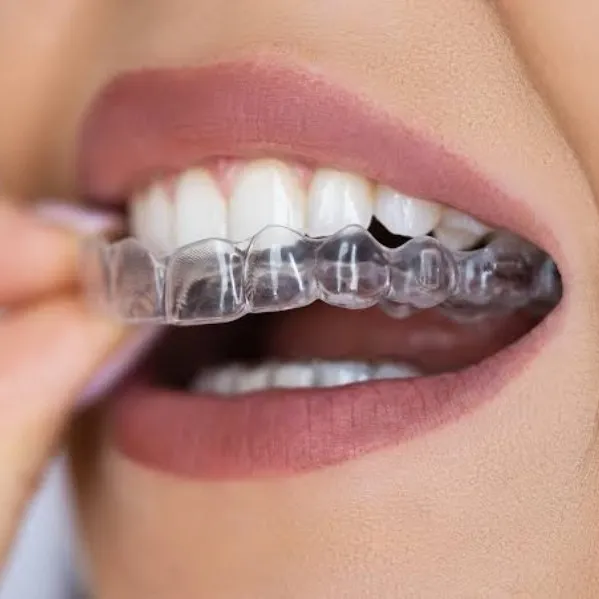 Clear Aligners in Thane: Treatment Timeline, Cost & Results