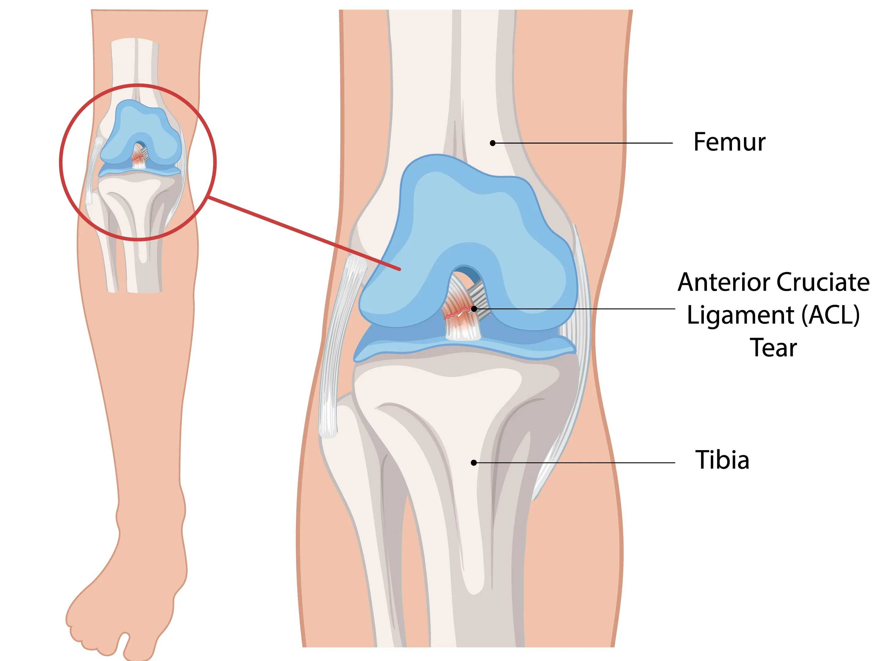 ACL Surgery Hospital in Pune