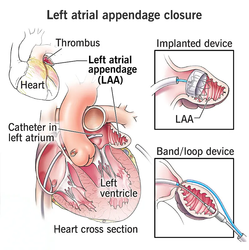 Left Atrial Appendage Closure in Navi Mumbai – Reducing Stroke Risk in Selected Patients
