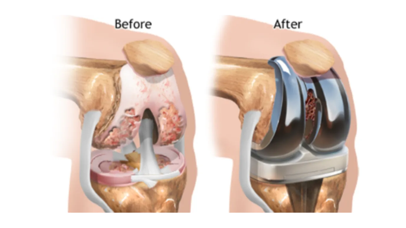 Joint Replacement Surgery in Ghatkopar – A New Beginning for Pain-Free Movement