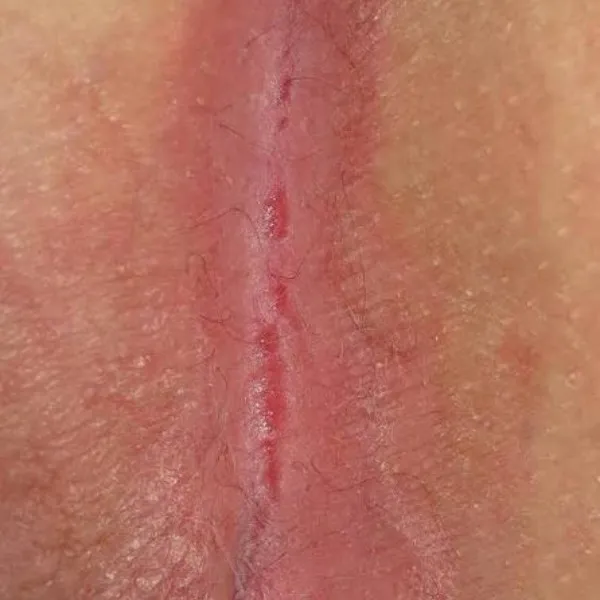 Treatment of psoriasis at Rakesh Reddy's Skin Clinic in Sanjay Nagar