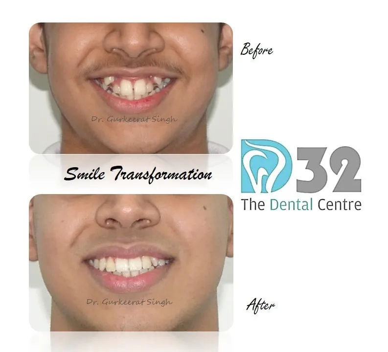 Clear Aligners in South Extension