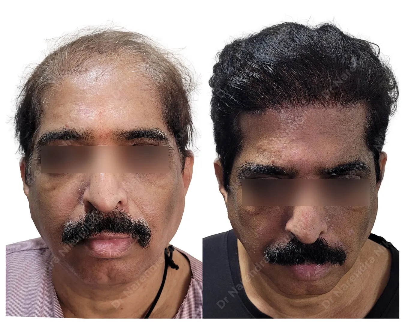 FUE Hair Transplant In Thane
