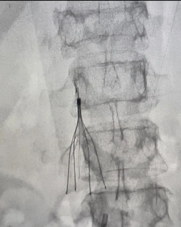 IVC Filter Implantation and Removal in Navi Mumbai – Protection Against Serious Blood Clot Complicat