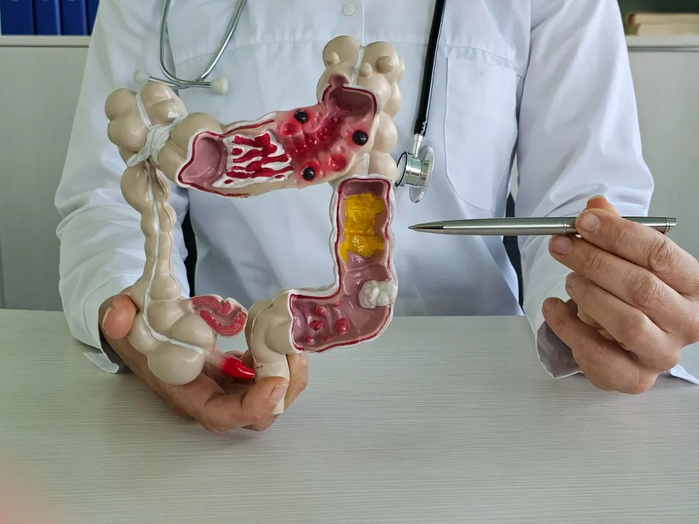 Colon Cancer Surgeon in Pune | Recognizing the Importance of Early Treatment