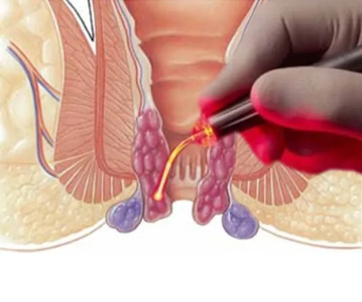 Laser Piles Surgery in Parel – Advanced Care for Persistent Haemorrhoids