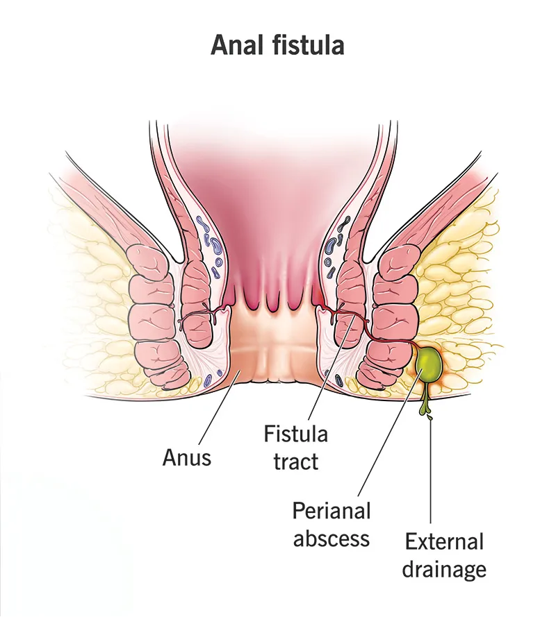 Fistula Treatment in Goregaon – Understanding a Condition That Rarely Heals on Its Own