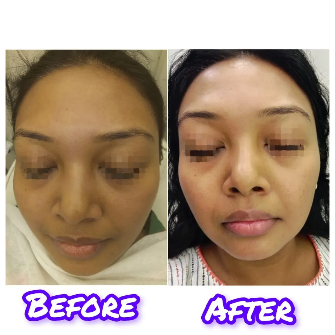 Best Derma Pen Treatment in Vashi