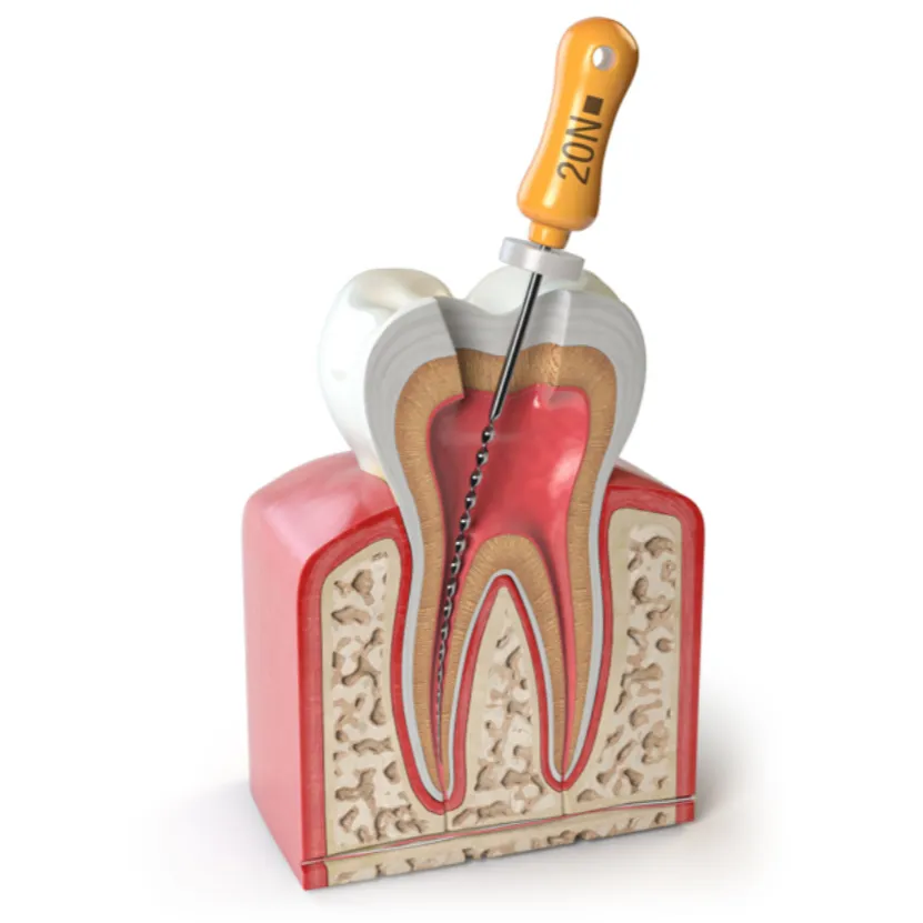 Root Canal Treatment in Kharadi