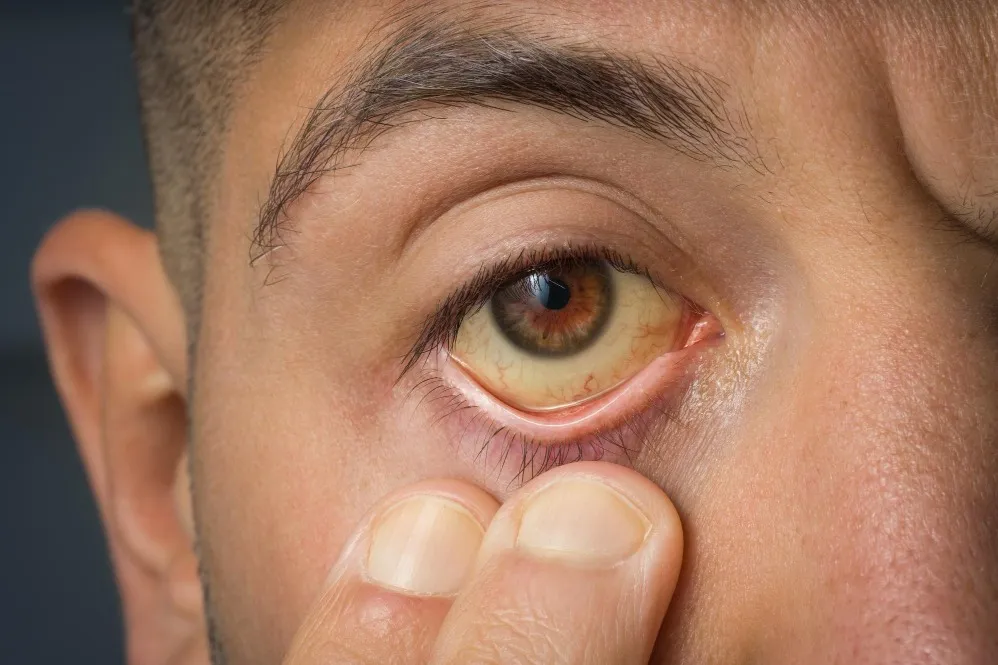 Jaundice Treatment Specialist in PCMC – When Yellow Eyes Signal an Underlying Problem