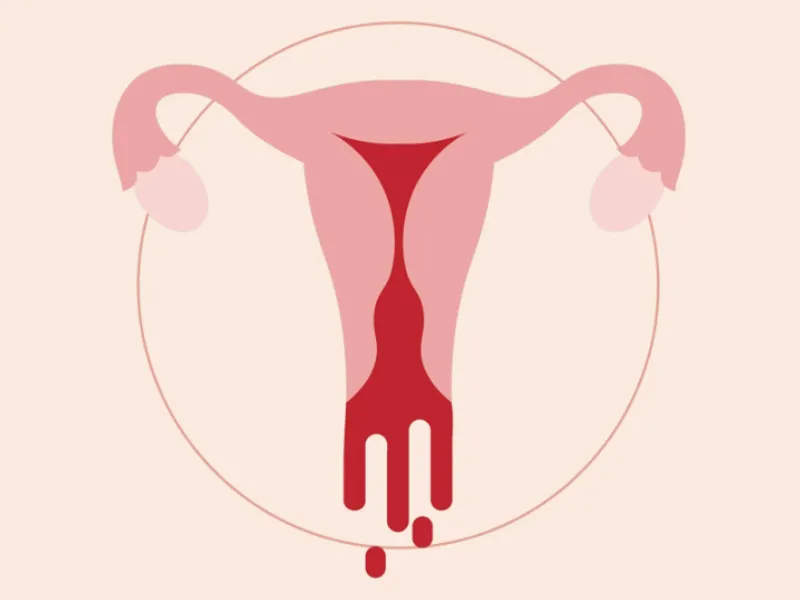 Heavy Menstrual Bleeding Treatment in Jogeshwari – When Your Period Starts Affecting Everyday Life