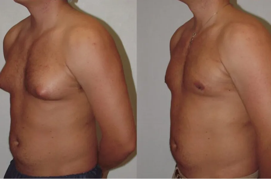 Gynecomastia Surgery in Kolathur Expert Surgical Care for Male Chest Enlargement