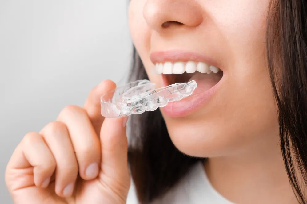 Clear Aligners Clinic in Delhi for Convenient Teeth Straightening