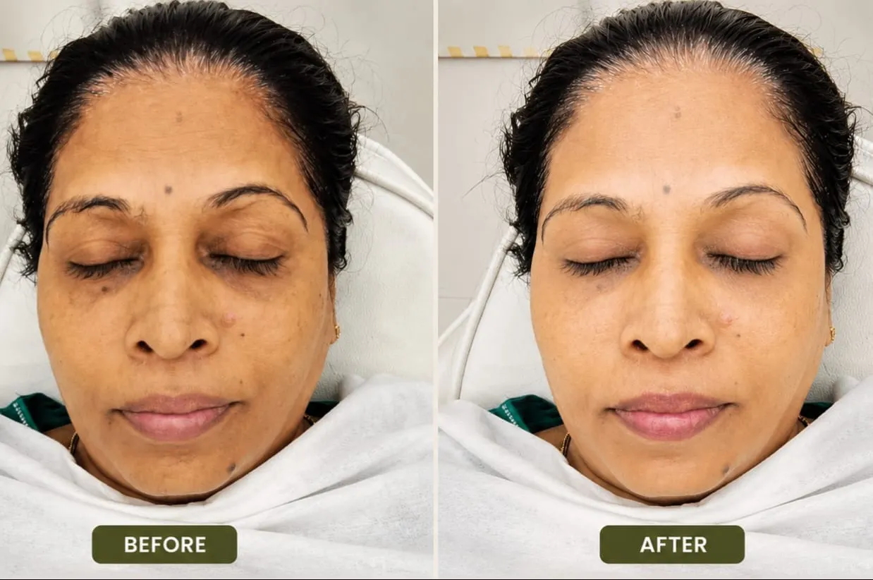 Hydrafacial Treatment In Vashi