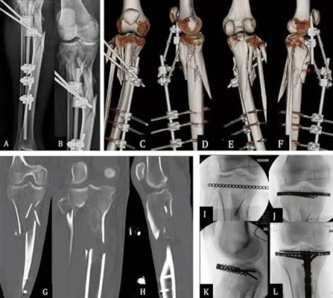Dr. Santosh Pandey – Orthopaedic Surgeon for Complex Fractures in Mira Road, Dahisar & Borivali